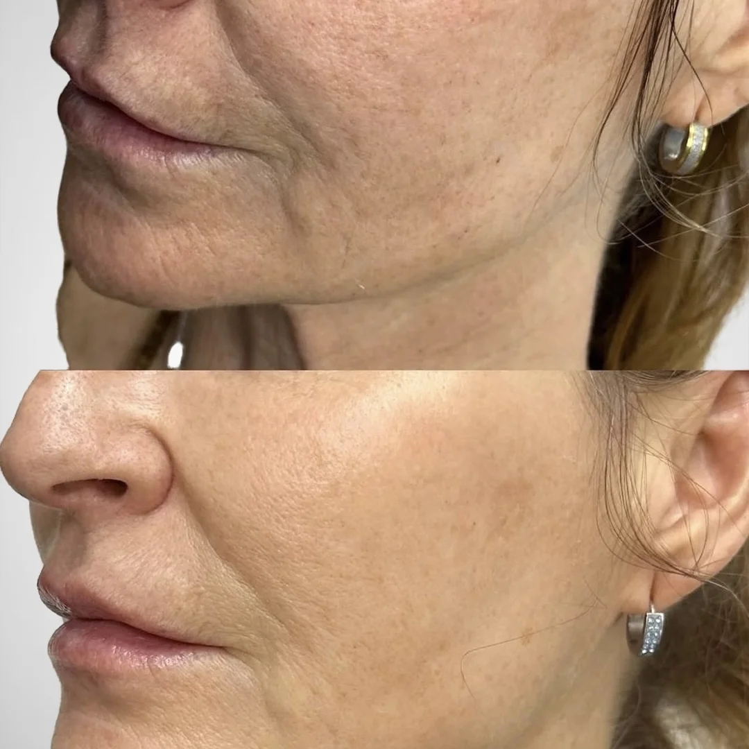 Lifting perioral con HIFU en Elyzea Miraflores — antes arriba mostrando líneas y flacidez, después abajo con piel tensada