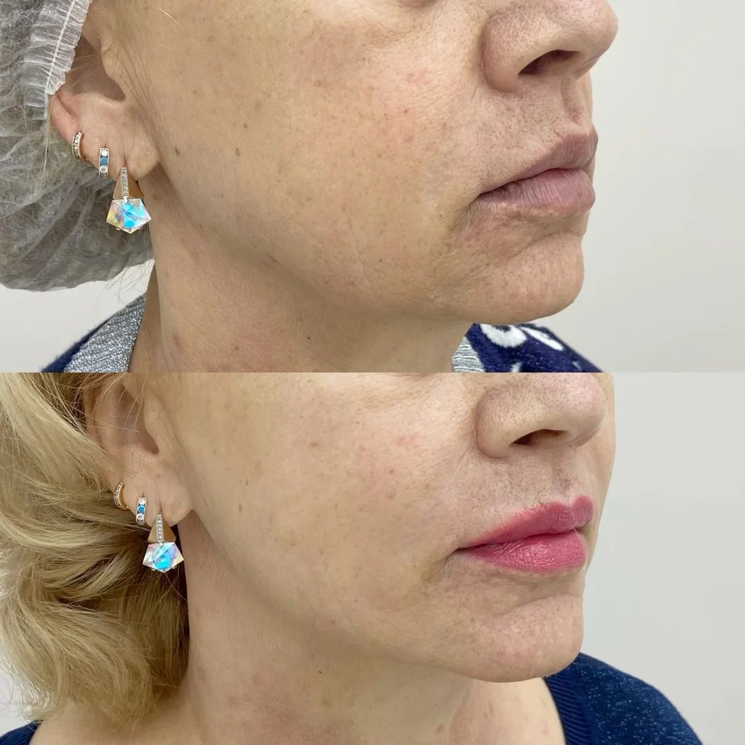 Lifting de mandíbula y mentón con HIFU en Elyzea Miraflores — antes arriba mostrando flacidez, después abajo con mandíbula definida
