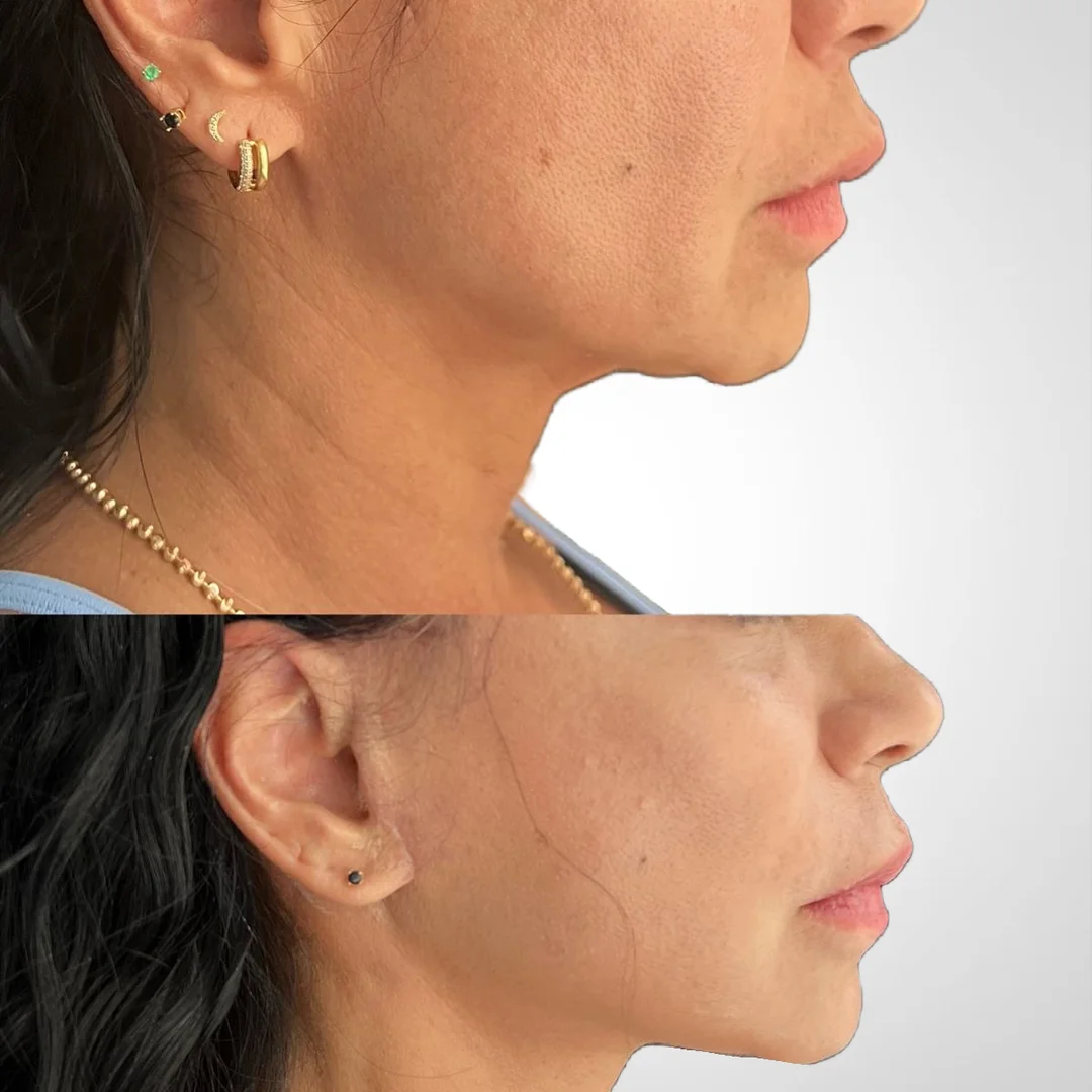 Tensado de cuello y reducción de papada con HIFU en Elyzea Miraflores — antes arriba con flacidez submentoniana, después abajo con contorno mandibular definido