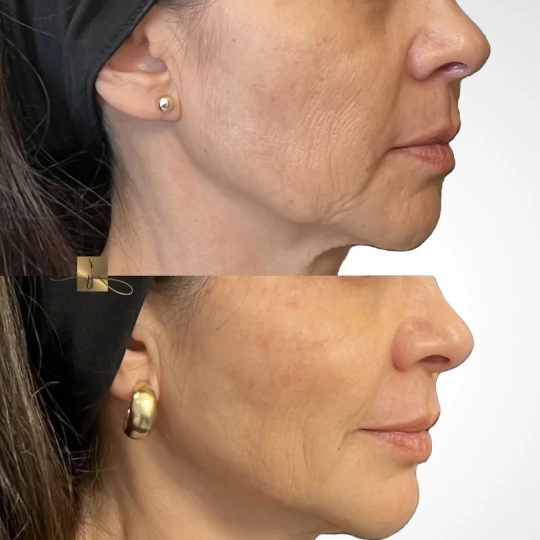 Rejuvenecimiento facial con HIFU en Elyzea Miraflores — antes arriba con pérdida de firmeza y líneas profundas, después abajo con piel visiblemente más firme