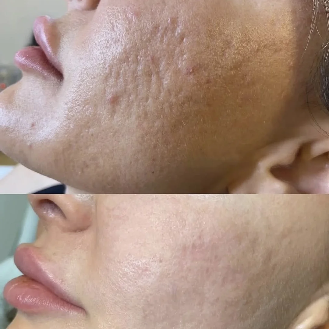 Acne scar treatment around chin with fractional CO₂ laser at Elyzea Miraflores — before on top, after on bottom