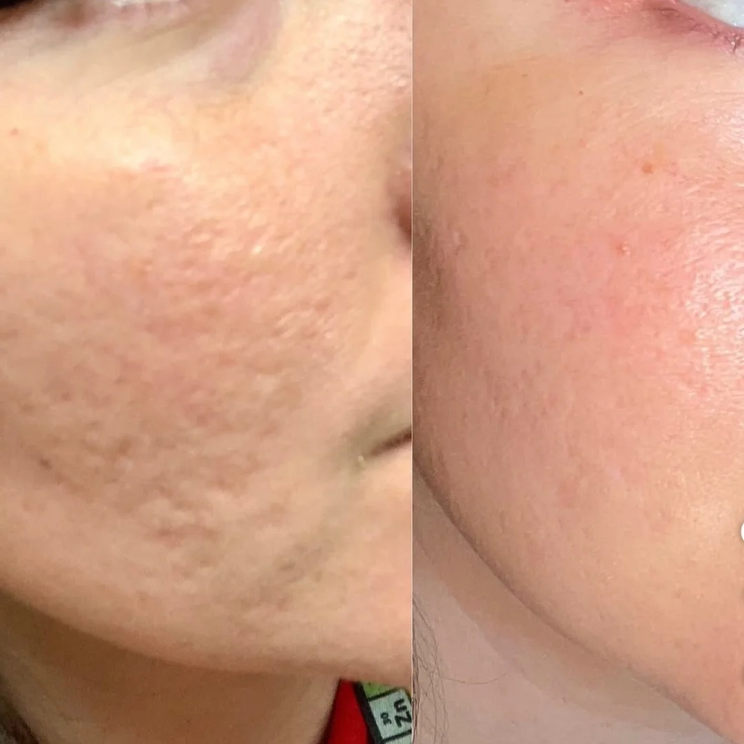 Atrophic acne scar treatment on cheek with fractional CO₂ laser at Elyzea Miraflores — before on left, after on right