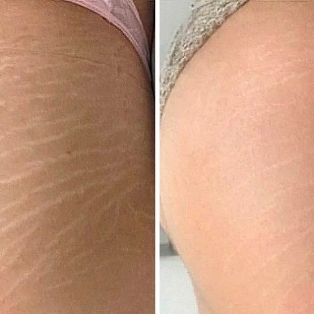 Stretch mark reduction on thigh with fractional CO₂ laser at Elyzea Miraflores — before on left, after on right