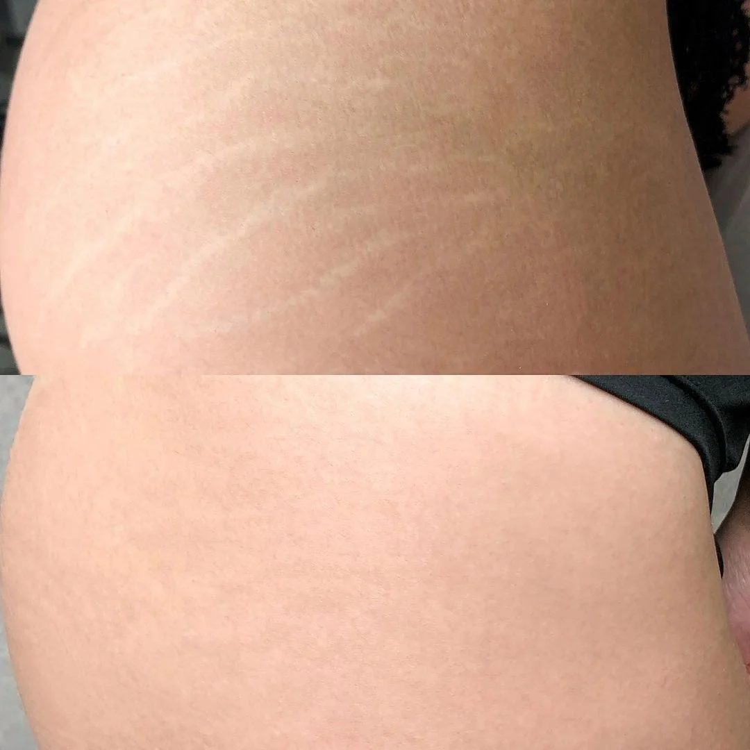 Stretch mark reduction on glutes with fractional CO₂ laser at Elyzea Miraflores — before on top, after on bottom