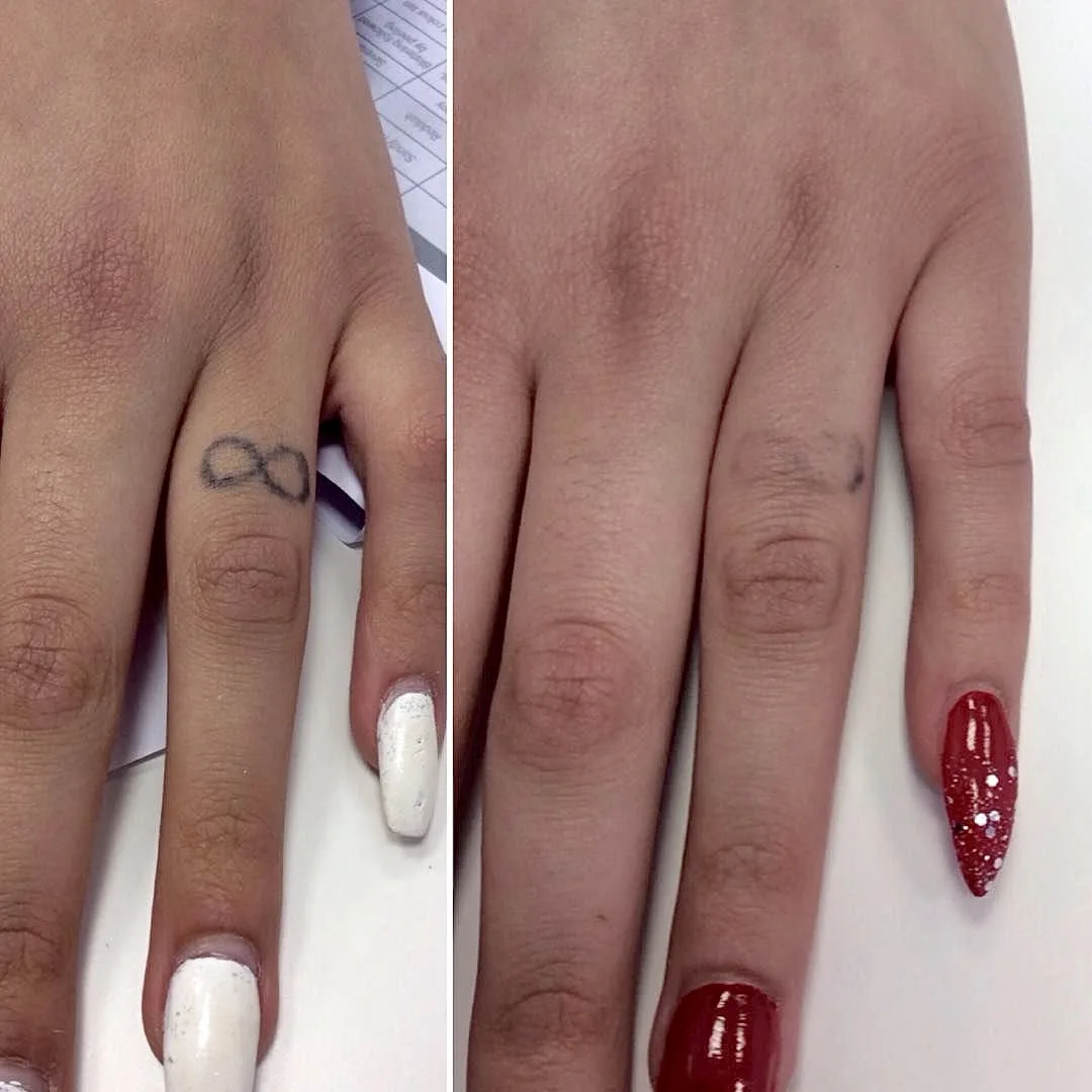 Infinity symbol finger tattoo removal with picosecond laser at Elyzea Miraflores — before on the left, after on the right following 3 sessions