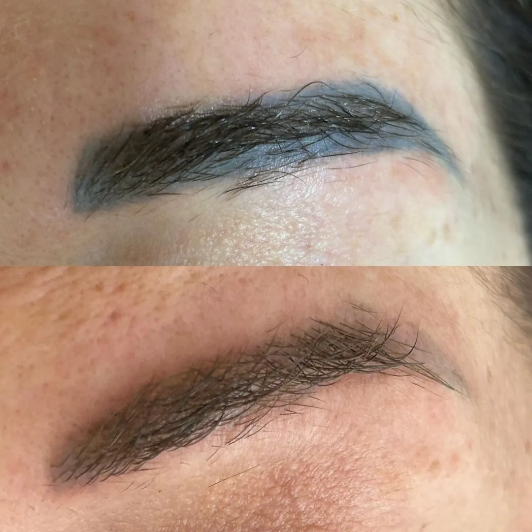 Old blue-gray eyebrow micropigmentation removal with picosecond laser at Elyzea Miraflores — before on top, after on bottom following 3 sessions