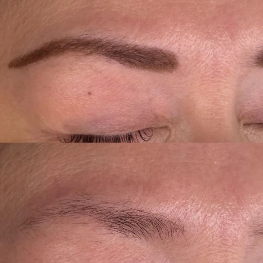 Brown microblading removal with picosecond laser at Elyzea Miraflores — before on top, after on bottom following 2 sessions