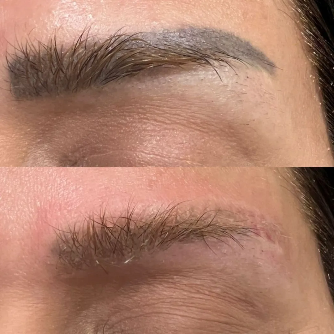 Eyebrow micropigmentation during picosecond laser session at Elyzea Miraflores — before the session on top, immediately after the 1st session on bottom showing the normal temporary frosting effect
