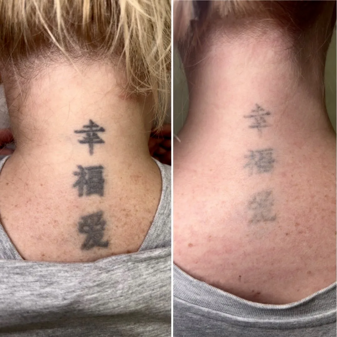 Chinese character neck tattoo removal with picosecond laser at Elyzea Miraflores — before on the left, after on the right following 1 session