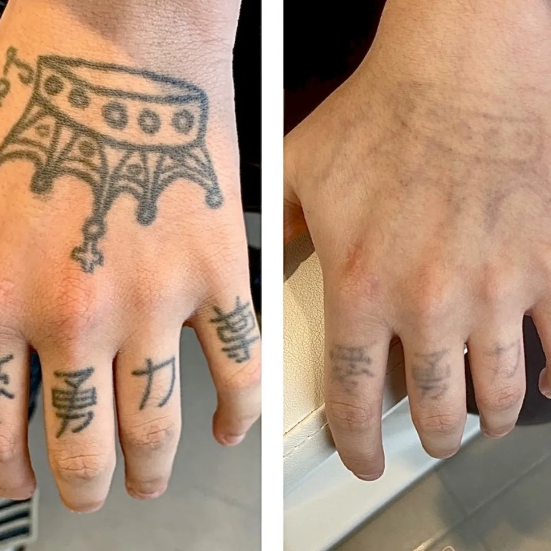 Tribal hand and finger tattoo removal with picosecond laser at Elyzea Miraflores — before on the left, after on the right following 4 sessions