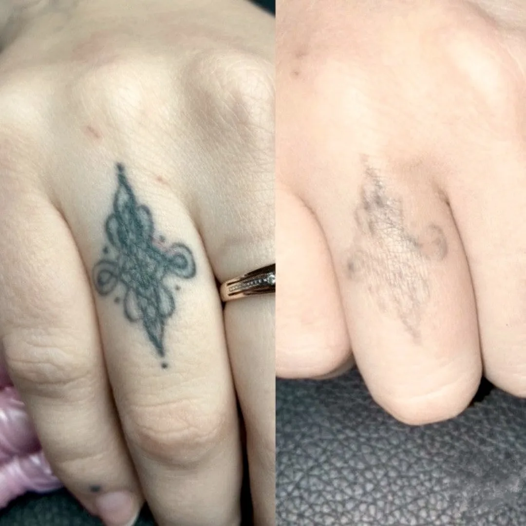 Ornamental ring-finger tattoo removal with picosecond laser at Elyzea Miraflores — before on the left, after on the right following 3 sessions