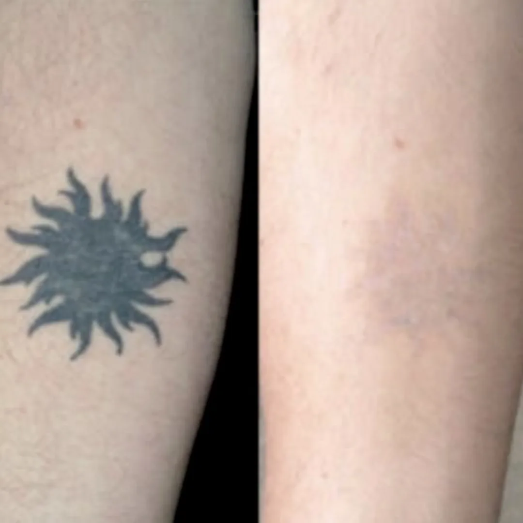 Tribal sun forearm tattoo removal with picosecond laser at Elyzea Miraflores — before on the left, after on the right following 5 sessions