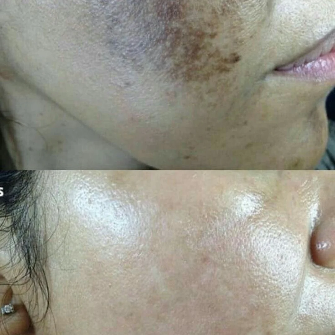 Severe facial hyperpigmentation removal with picosecond laser at Elyzea Miraflores — before on top, after on bottom