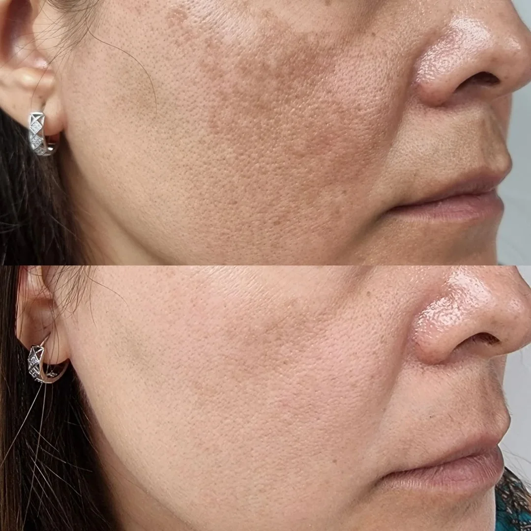 Jawline melasma reduction with picosecond laser at Elyzea Miraflores — before on top, after on bottom