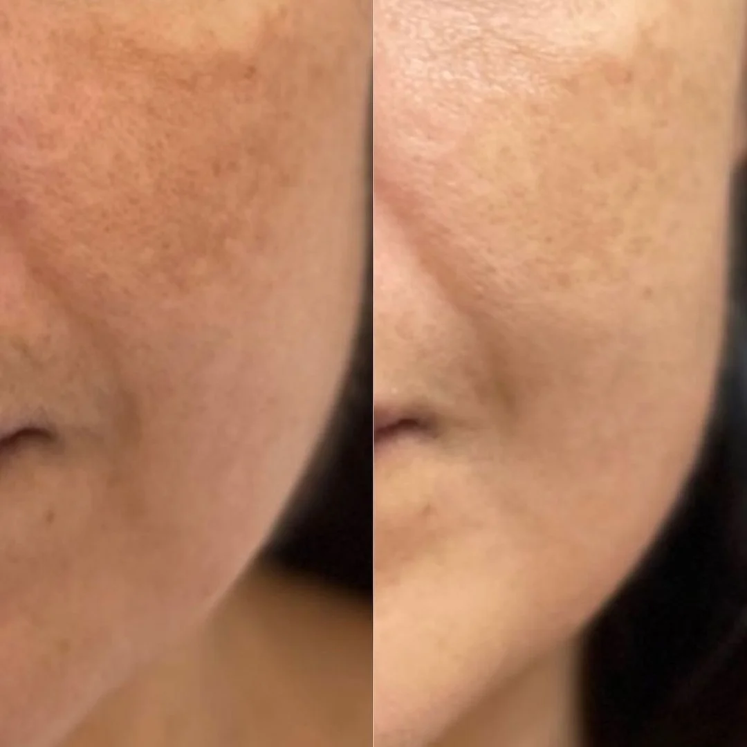 Sun spot reduction on cheek with picosecond laser at Elyzea Miraflores — before on left, after on right