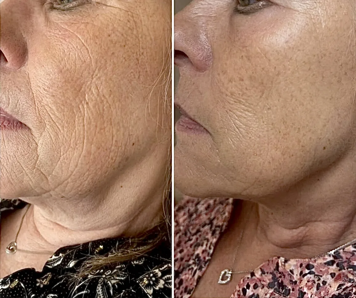 Facial rejuvenation with Morpheus8 at Elyzea Miraflores — before on the left with deep cheek wrinkles, after on the right with visibly smoother and firmer skin