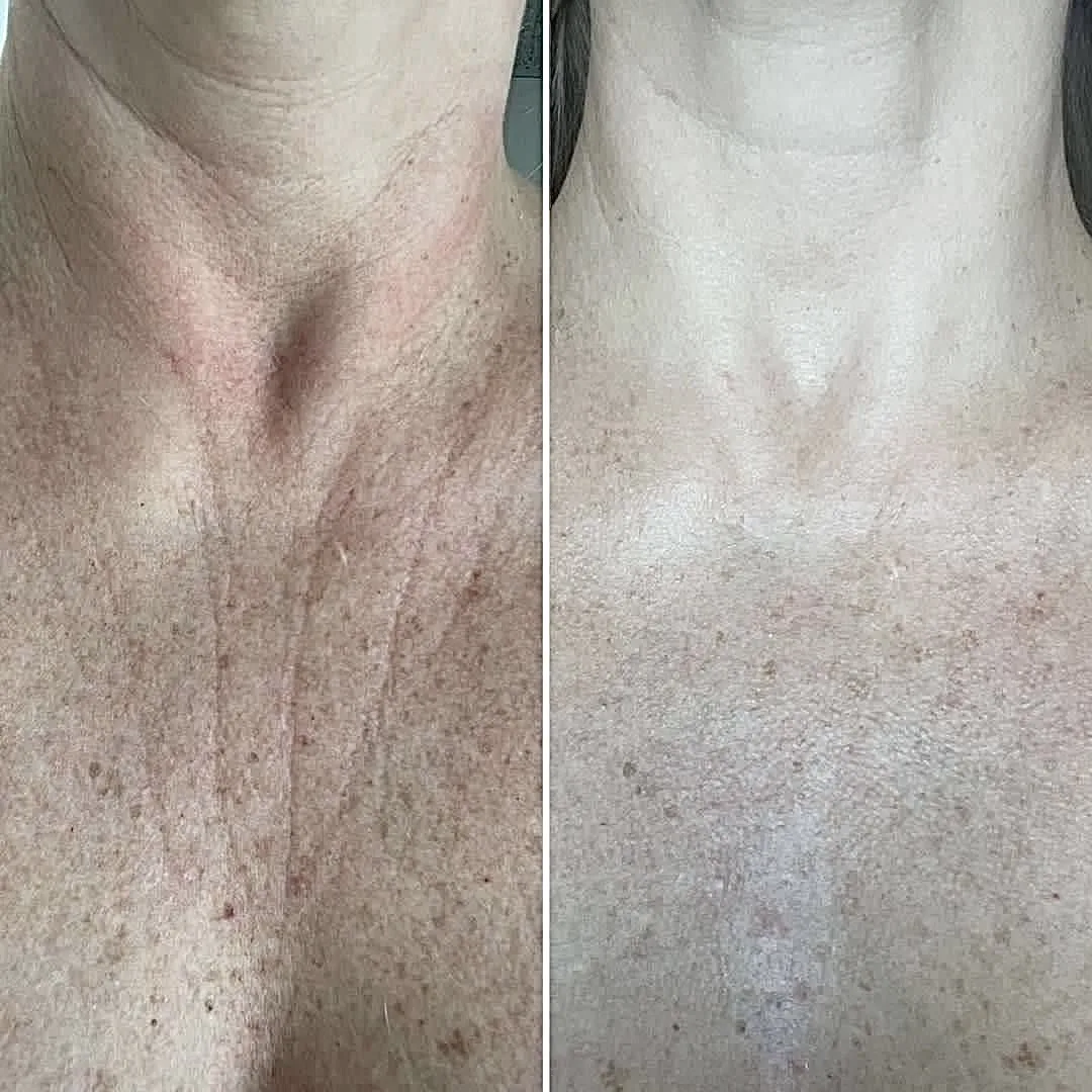 Neck and d&eacute;colletage rejuvenation with Morpheus8 at Elyzea Miraflores — before on the left with wrinkles and sun damage, after on the right with smoother and more even skin
