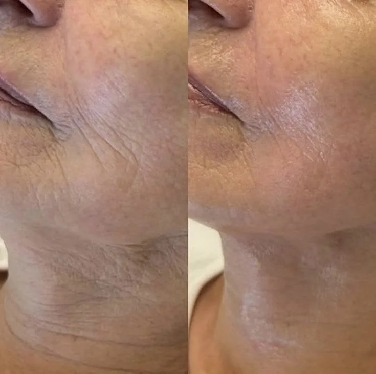 Jawline skin tightening with Morpheus8 at Elyzea Miraflores — before on the left with deep wrinkles, after on the right with significantly firmer skin